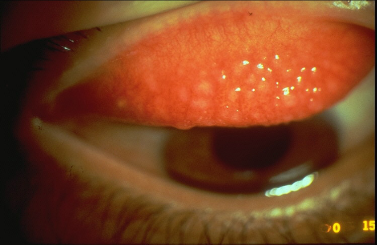 Lids and Palpebral Conjunctiva- photos : Bausch + Lomb